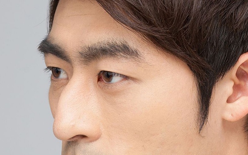 Nâng mũi không phẫu thuật: Giải pháp nhanh chóng cho dáng mũi đẹp