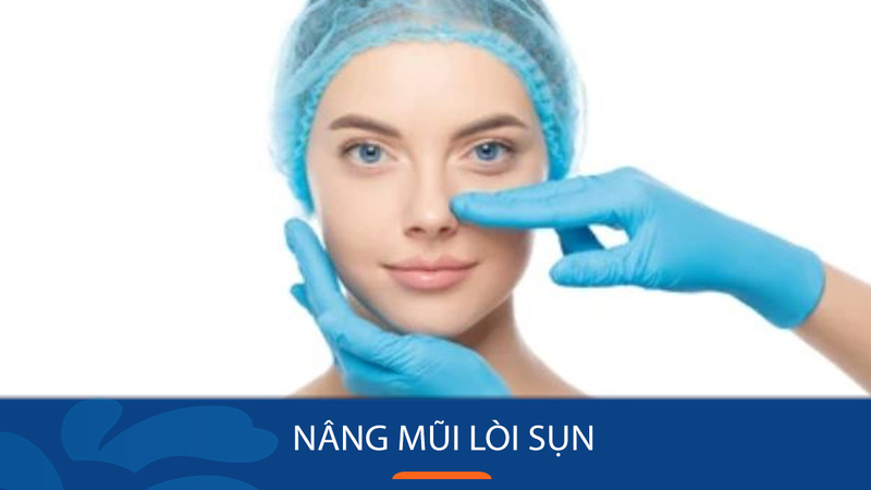 Tìm hiểu về nâng mũi lòi sụn ( Nguồn: Internet )