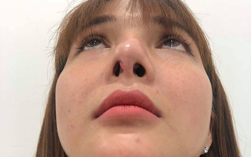 Dấu hiệu của nâng mũi lòi sụn (Nguồn: Internet)