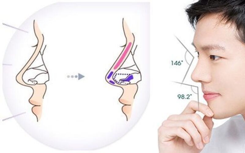 Tại sao nam giới nên nâng mũi? (Nguồn: Internet)