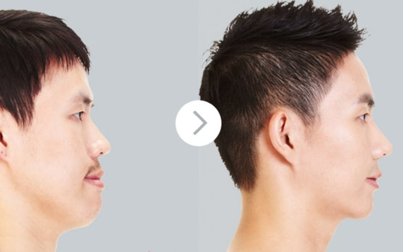 So với nâng mũi nữ, nâng mũi cho nam có những điểm khác biệt (Nguồn: Internet)