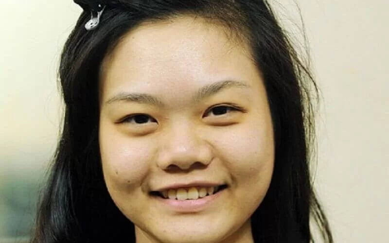 Mũi tẹt thích hợp nâng mũi S line (Nguồn: Internet)