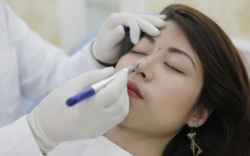 Quy trình nâng mũi (Nguồn: Internet)