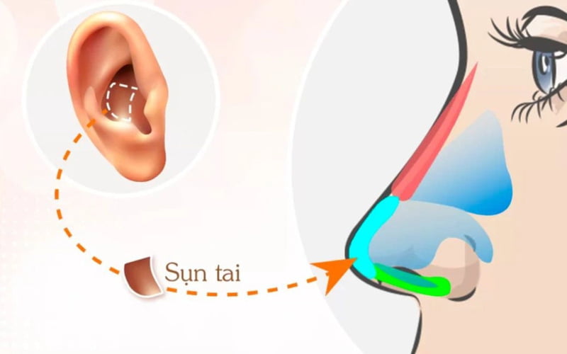 Nâng mũi sụn tai là phương pháp thẩm mỹ mũi sử dụng sụn tự thân từ vành tai để tạo hình dáng mũi đẹp (Nguồn: Internet)