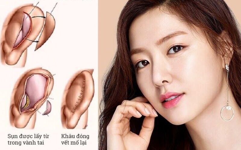 Có nên nâng mũi bằng sụn tai không? (Nguồn: Internet)