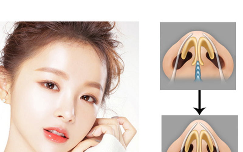 Giải đáp các thắc mắc thường gặp về nâng mũi lấy sụn tai (Nguồn: Internet)