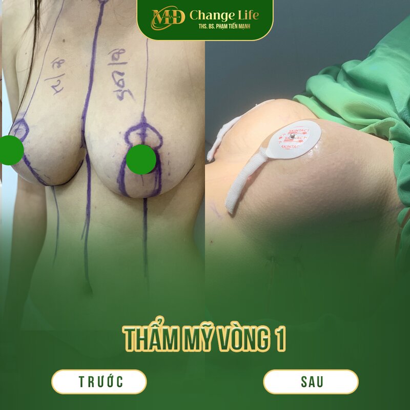 Thẩm mỹ MD Change Life - Địa điểm cải thiện vòng một uy tín tại Hà Nội (Nguồn: MD Change Life)