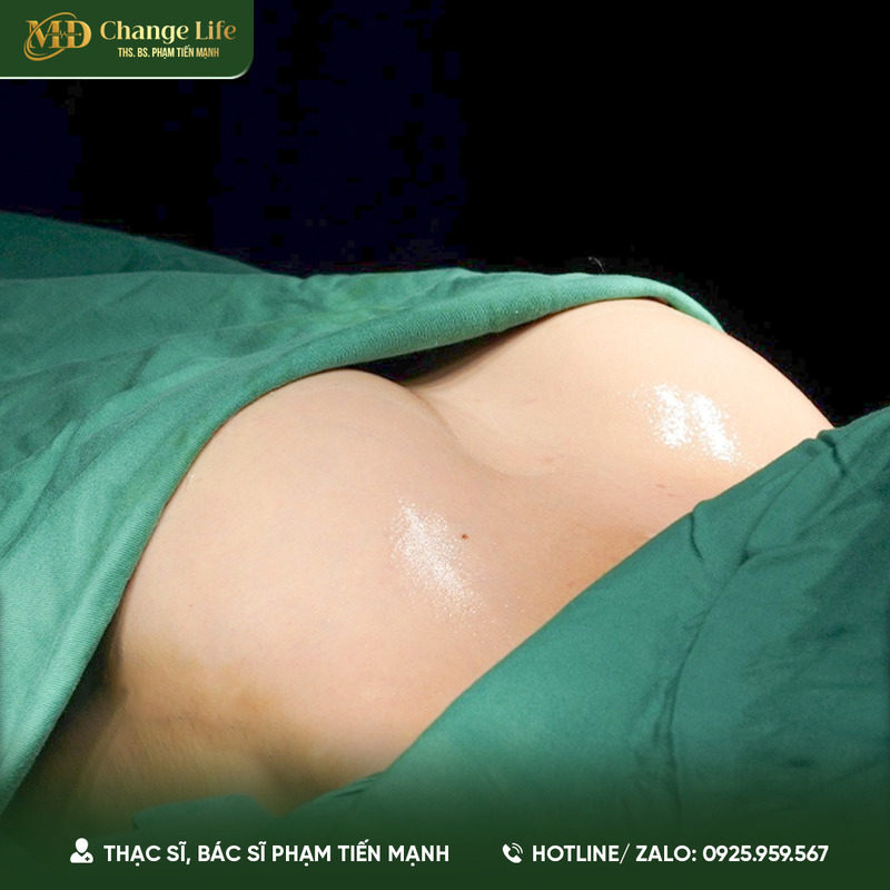 Nâng ngực bao nhiêu tiền? (Nguồn: Thẩm Mỹ MD Change Life)