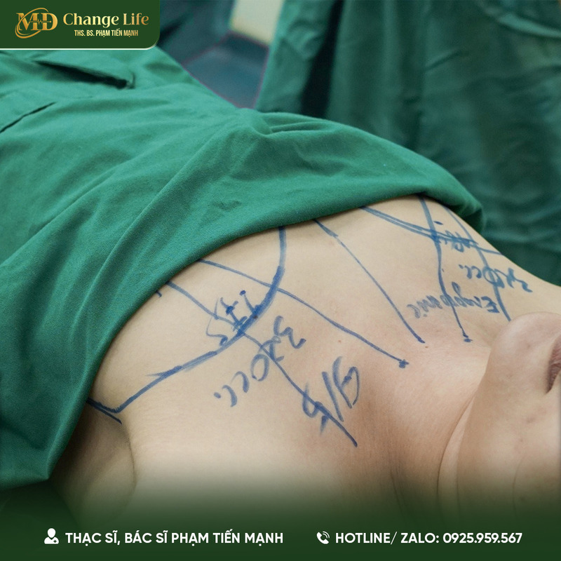 Lưu ý quan trọng về nâng ngực bao nhiêu tiền (Nguồn: Thẩm Mỹ MD Change Life)