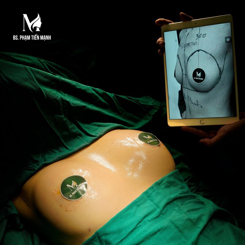 Giải đáp thắc mắc thường gặp về câu hỏi nâng ngực bao nhiêu tiền (Nguồn: Thẩm Mỹ MD Change Life)