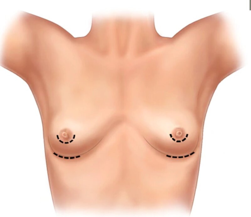 Nâng ngực chuyển giới dần được phổ biến rộng rãi (Nguồn: Internet)