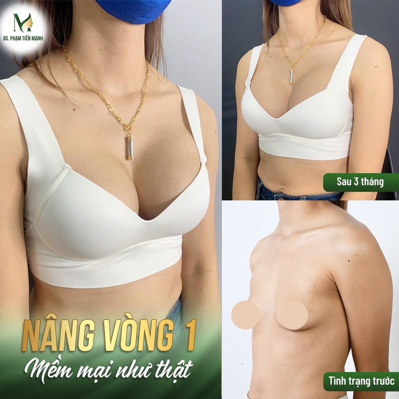 Nâng ngực chạm đến ước mơ vòng một hoàn hảo tại Thẩm mỹ MD Change Life (Nguồn: MD Change Life)