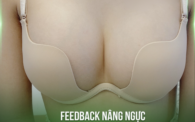 Nâng ngực Hà Nội tại MD Change Life (Nguồn: MD Change Life)