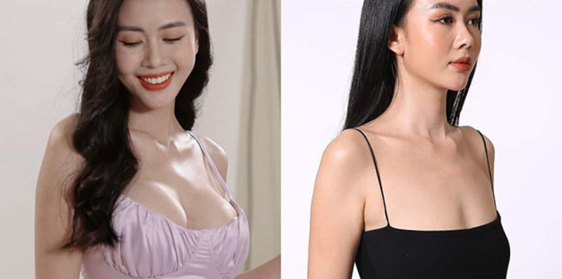 Kangnam: Địa chỉ nâng ngực Hà Nội an toàn (Nguồn: Internet)