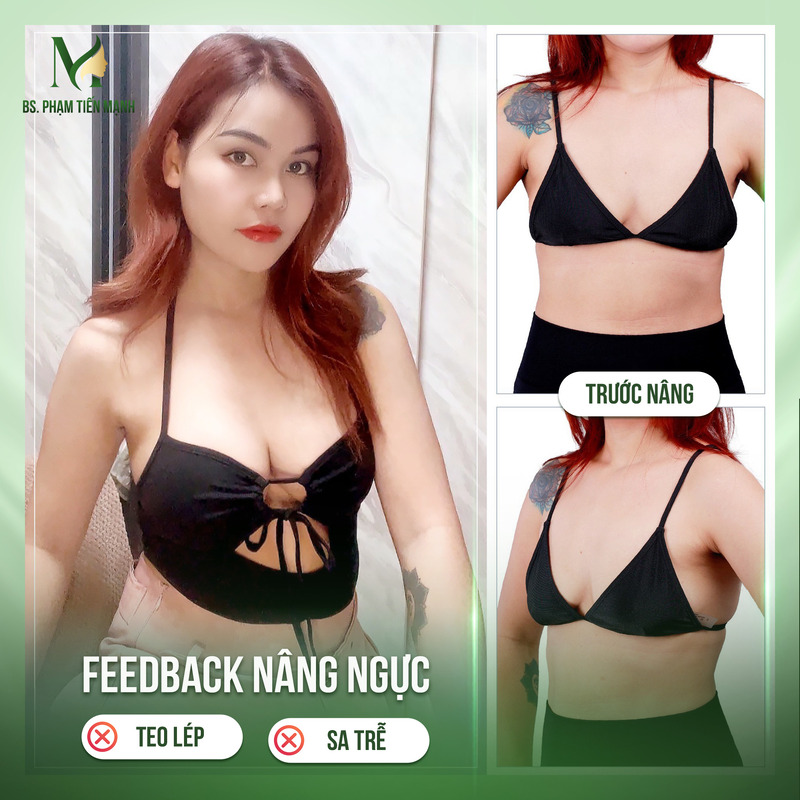 Nâng ngực size 350 phù hợp với những ai? (Nguồn: Thẩm Mỹ MD Change Life)