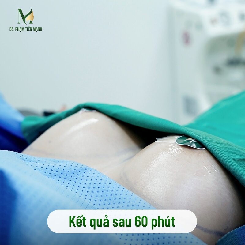 Quy trình nâng ngực size 350 diễn ra như thế nào? (Nguồn: Thẩm Mỹ MD Change Life)