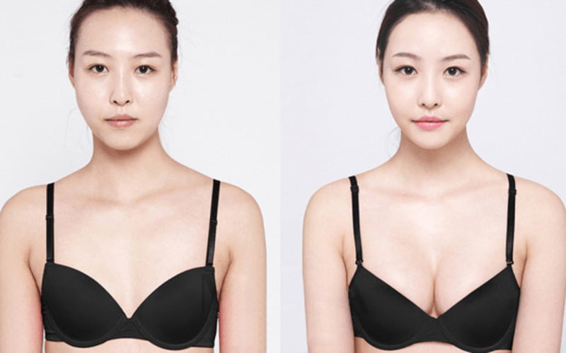 Nâng ngực sửa lại giúp khắc phục hiệu quả những khuyết điểm (Nguồn: Internet)