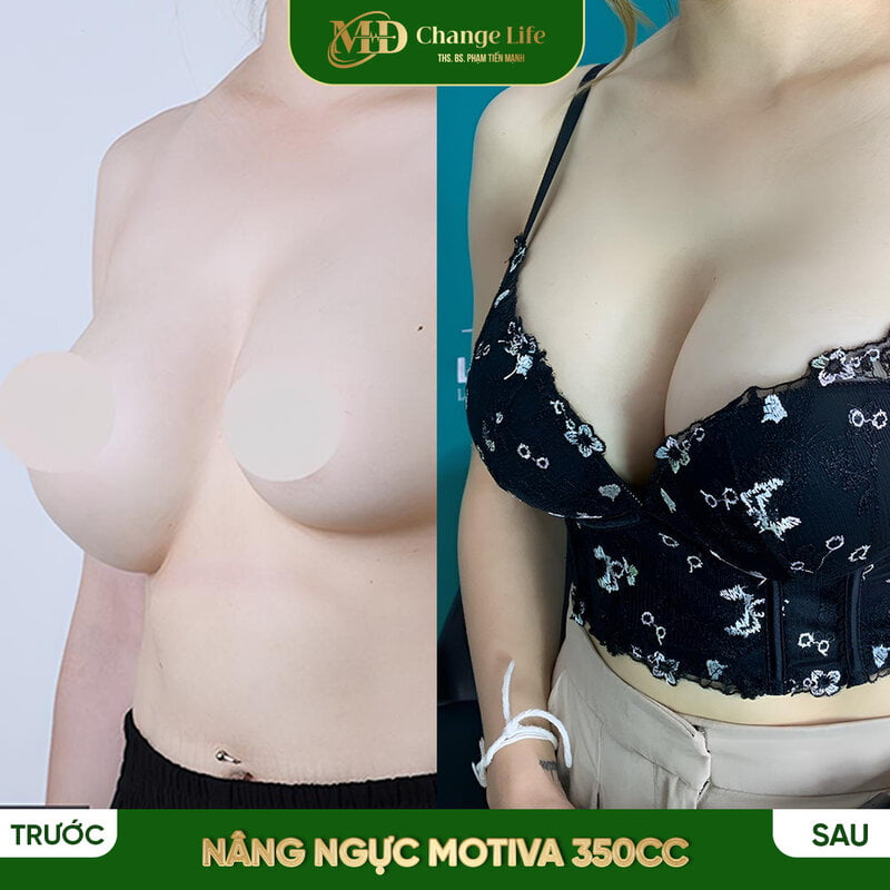 Thẩm mỹ MD Change Life - Nơi uy tín, an toàn cho bạn thực hiện nâng ngực (Nguồn: Internet)