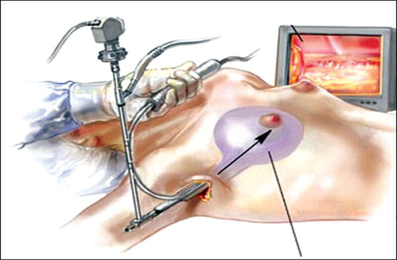 Phương pháp nâng ngực túi nanochip nội soi (Nguồn: Internet)