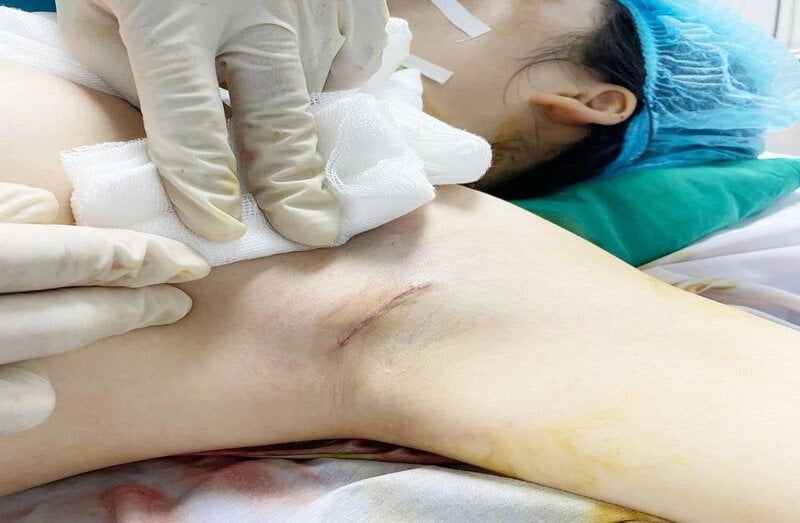 Phẫu thuật nâng ngực bằng đường nách (Nguồn: Internet)