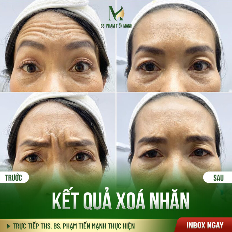 Kết quả xóa nếp nhăn cau mày tại Thẩm Mỹ MD Change Life (Nguồn: Thẩm Mỹ MD Change Life)