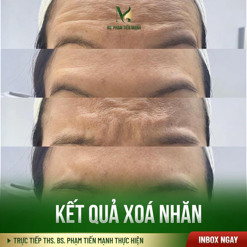 Xóa nếp nhăn trẻ hóa gương mặt hiệu quả tại Thẩm Mỹ MD Change Life (Nguồn: MD Change Life)