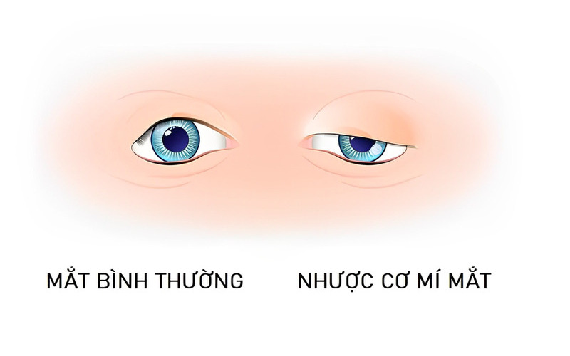 Phân biệt mắt thường và nhược cơ mí mắt ( Nguồn: Internet )