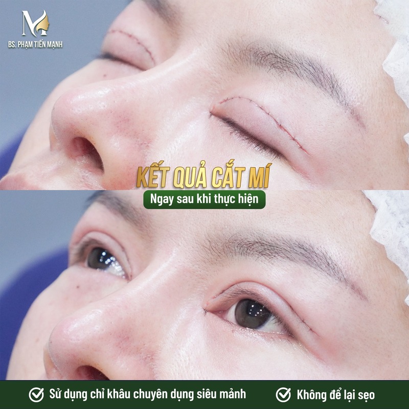 Kết quả khách cắt mí sau khi phẫu thuật tại MD Change Life (Nguồn: MD Change Life)