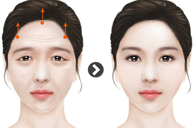 Phương pháp phẫu thuật căng da mặt là như thế nào (Nguồn: Internet)