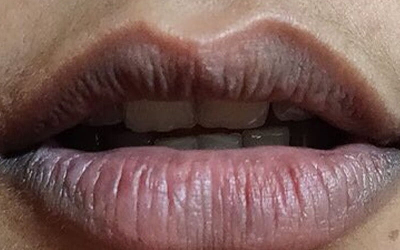 Đối tượng cần phẫu thuật tạo hình môi (Nguồn: Internet)