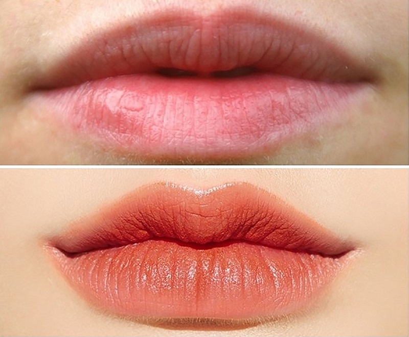 Lưu ý khi thực hiện phẫu thuật tạo khóe môi cười (Nguồn: Internet)