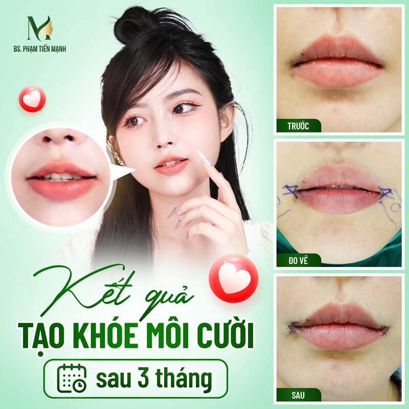 Dịch vụ tạo khóe môi cười tại Thẩm Mỹ MD Change Life (Nguồn: Thẩm Mỹ MD Change Life)