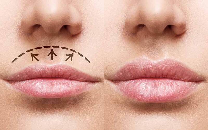 Quy trình phẫu thuật thu ngắn nhân trung tại Dr Phạm Tiến Mạnh (Nguồn: Internet)