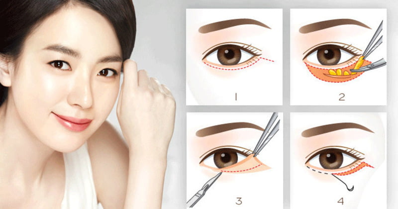 Review cắt mí dưới (Nguồn: Internet)