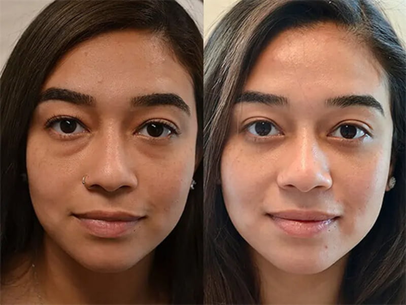 Thẩm Mỹ MD Change Life - Địa chỉ cắt mí dưới uy tín an toàn (Nguồn: MD Change Life)