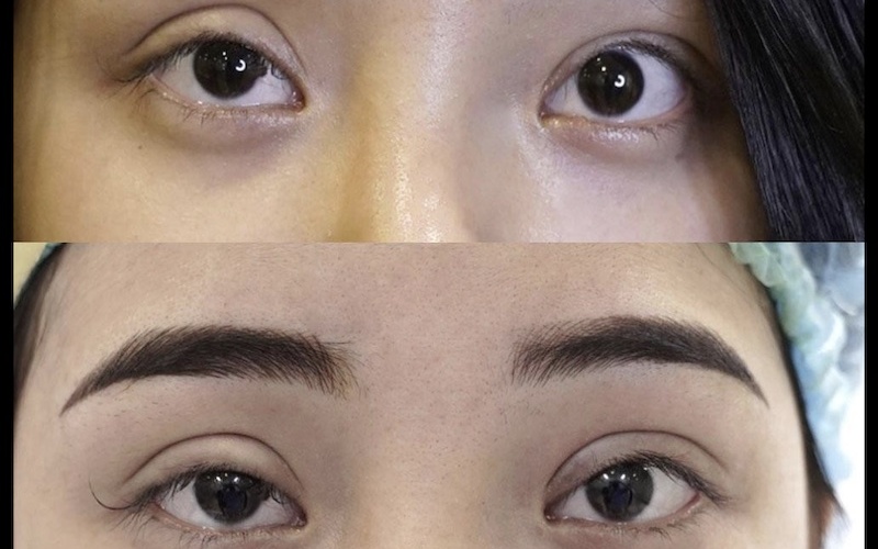 Mắt bị trợn sau cắt mí (Nguồn: Internet)