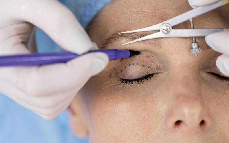 Sửa mắt bị trợn (Nguồn: Internet)