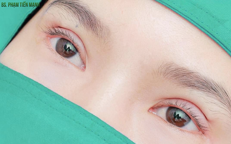 Sửa mắt bị trợn tại Thẩm mỹ MD Change Life (Nguồn: MD Change Life)