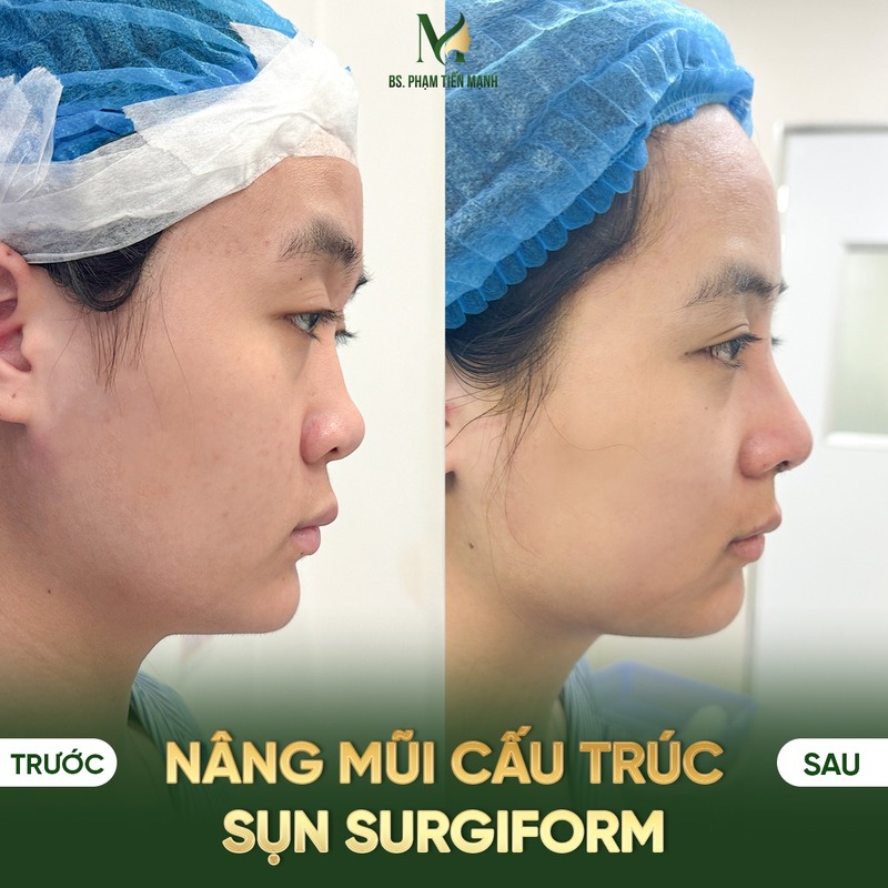 Các phương pháp cải thiện mũi hếch (Nguồn: MD Change Life)