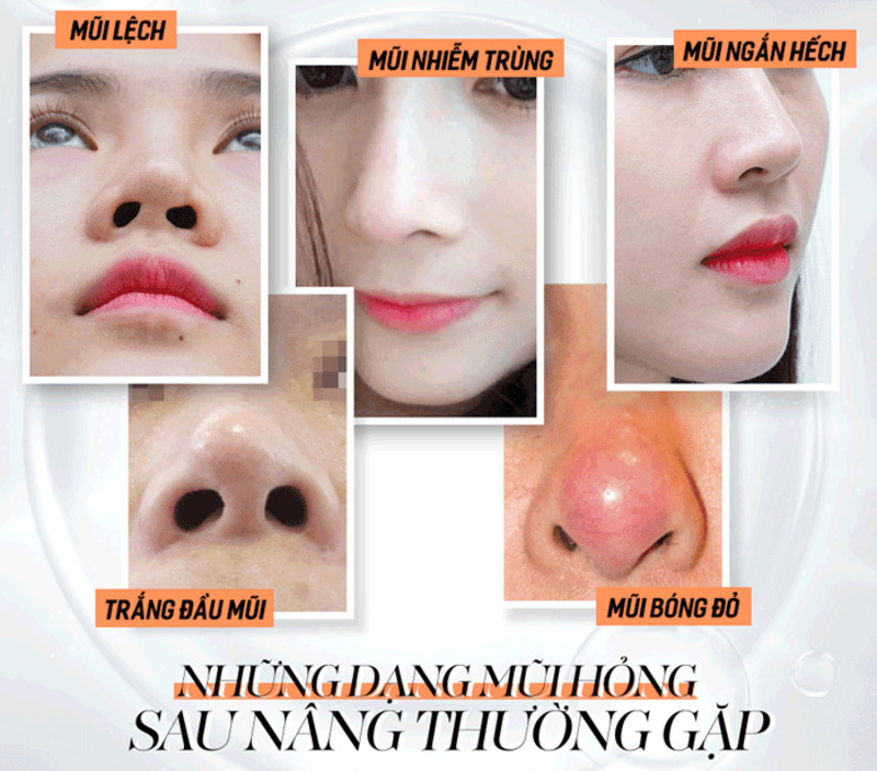 Những trường hợp sửa mũi hỏng sau nâng thường gặp (Nguồn: Internet)