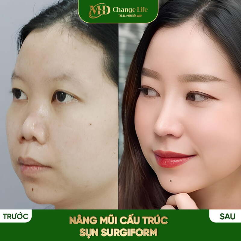 Hình ảnh khách hàng nâng mũi tại MD Change Life ( Nguồn: MD Change Life )