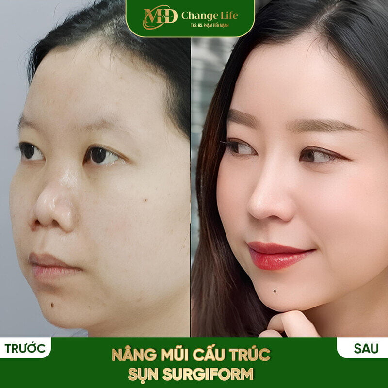 Nâng mũi cấu trúc tại Thẩm mỹ MD Change Life (Nguồn: MD Change Life)