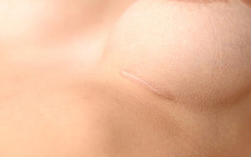 Sẹo ngực có thể hình thành do nhiều nguyên nhân khác nhau (Nguồn: Internet)