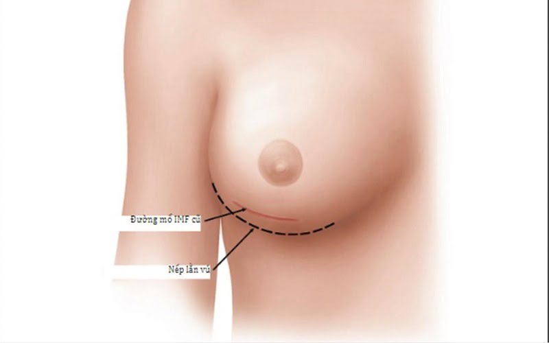 Cắt bỏ sẹo là phương pháp truyền thống được áp dụng cho các trường hợp sẹo lồi, sẹo phì đại (Nguồn: Internet)