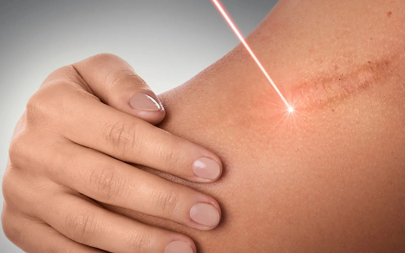 Phương pháp xóa mờ sẹo bằng công nghệ Laser (Nguồn: Internet)