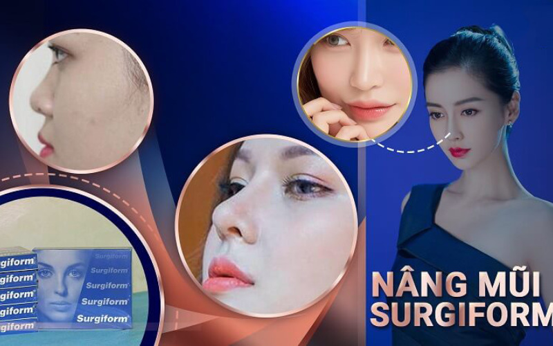 Ưu điểm vượt trội của sụn surgiform trong nâng mũi (Nguồn: Internet)