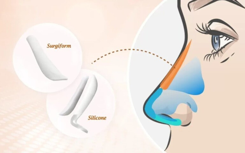 So sánh sụn Surgiform với các loại sụn khác (Nguồn: Internet)