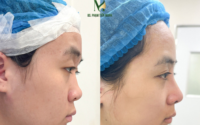 Nâng mũi Surgiform - Đột phá mới cho vẻ đẹp tự nhiên tại Thẩm Mỹ MD Change Life (Nguồn: MD Change Life)