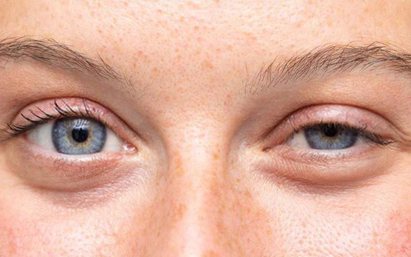 Sụp Mí: Giải Mã Nguyên Nhân, Triệu Chứng & Cách Điều Trị Hiệu Quả