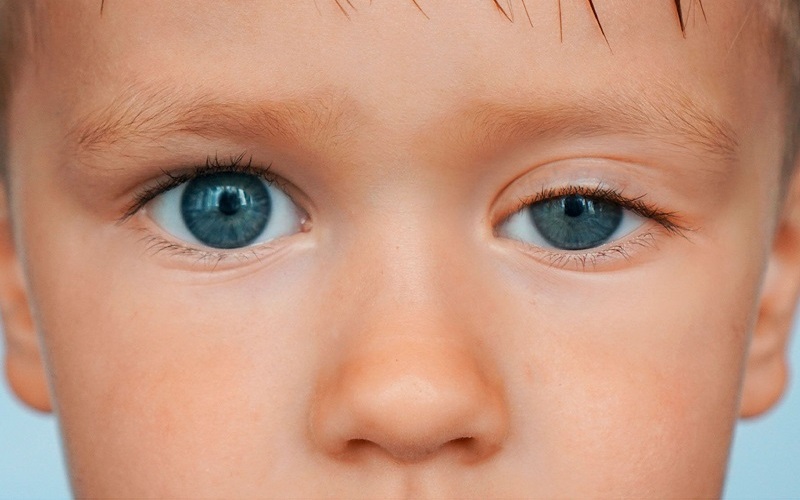 Sụp Mí: Giải Mã Nguyên Nhân, Triệu Chứng & Cách Điều Trị Hiệu Quả